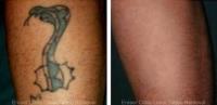 Eraser Clinic Laser Tattoo Removal image 2